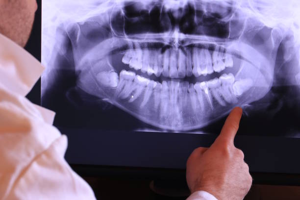 Best Knocked-Out Tooth (Avulsed Tooth) Treatment in Lmdale, PA